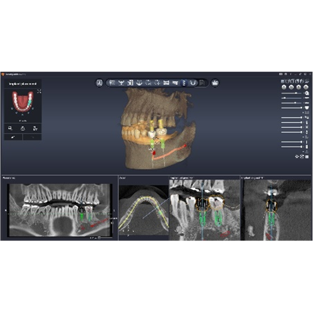 [3D Industrial] DentiqGuide